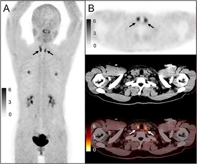 Clinical Significance of Diffusely Increased Uptake of 68Ga-FAPI in Thyroid Gland